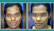 Skin Whitening Injections in Mumbai